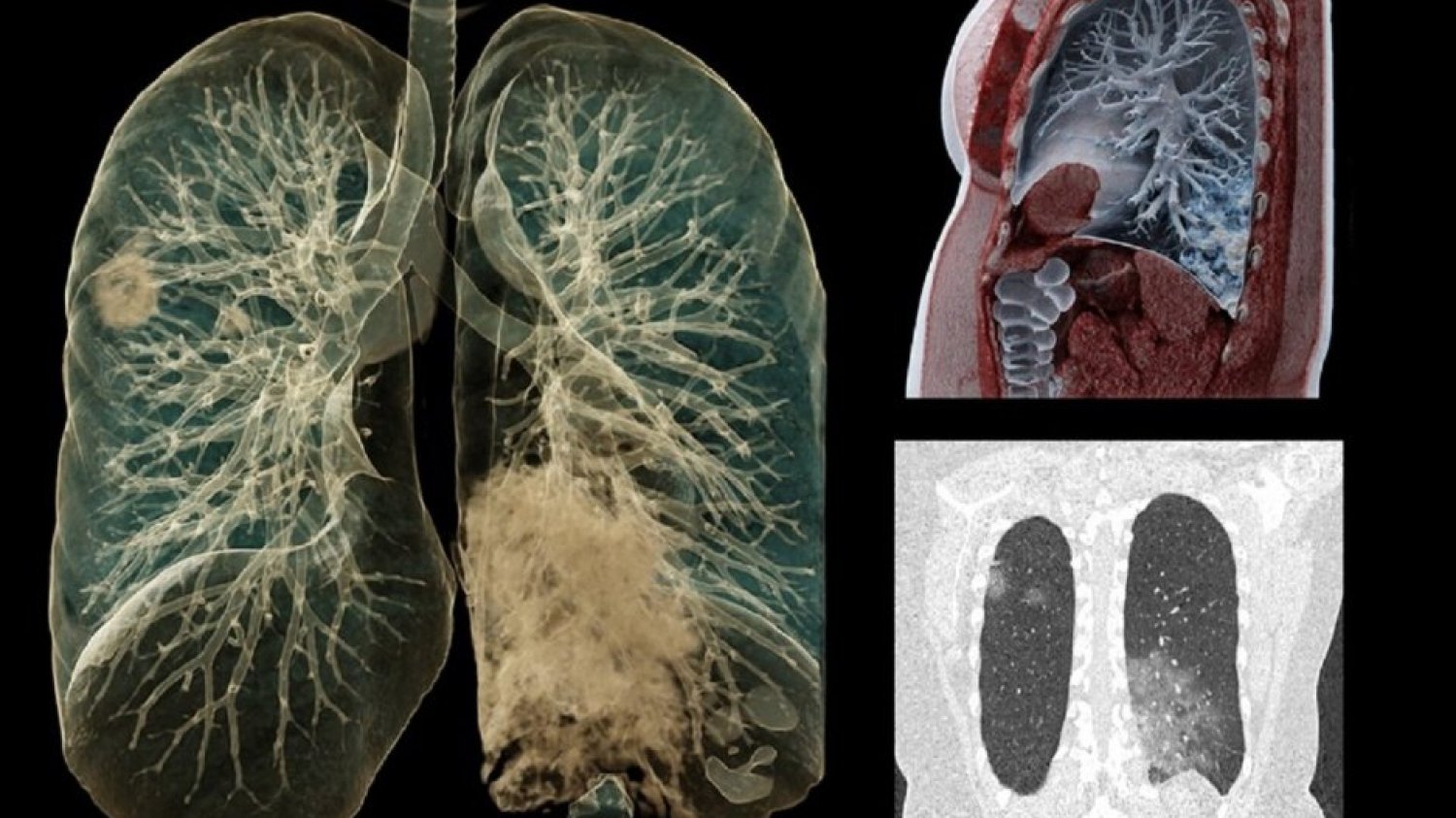 U osób, które przeszły COVID-19 łagodnie, lekarze diagnozują poważne zmiany m.in. w płucach. / Zdjęcie ilustracyjne