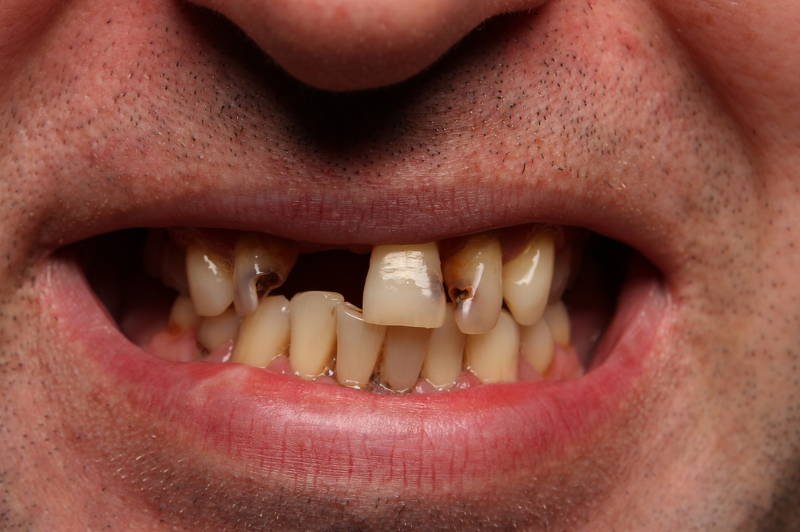 Czasami kolor zębów jest ich najmniejszą wadą...
