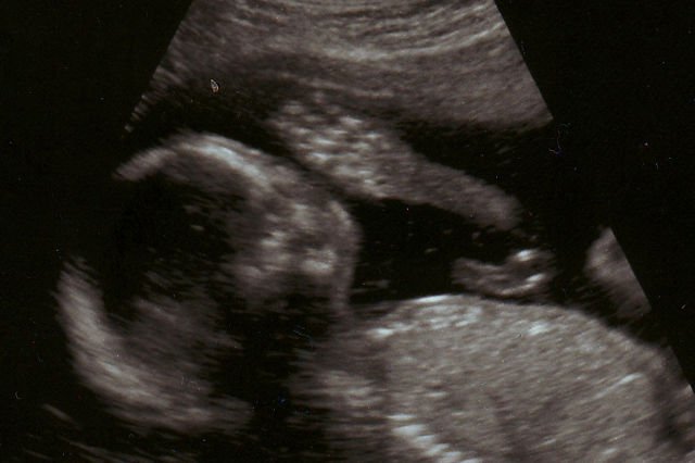 Aborcja jest legalna w Anglii, Szkocji i Walii do 24. tygodnia ciąży