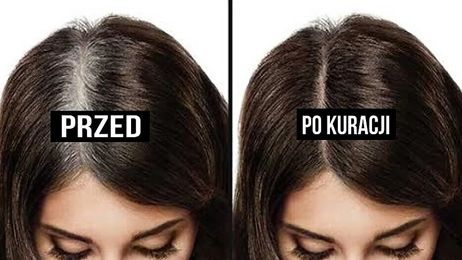 Domowe sposoby na siwe włosy. Naturalne odsiwianie [cytryna, olej kokosowy]