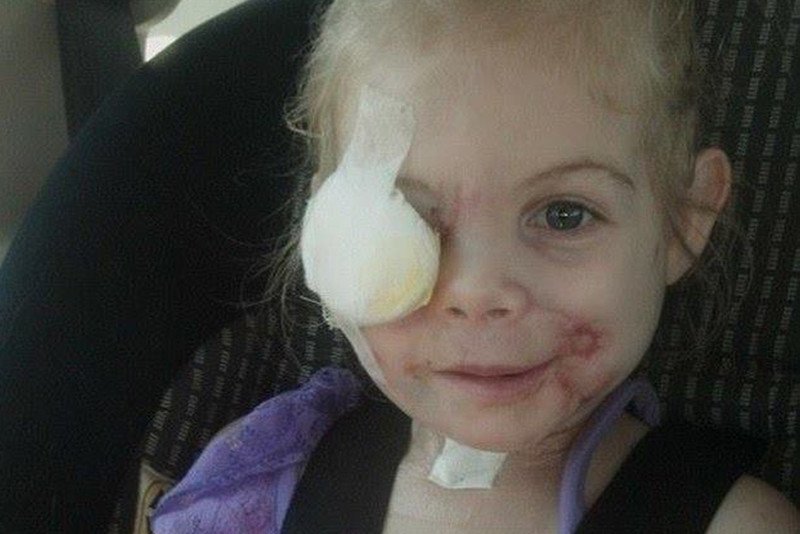 Trzylatka była zaatakowana przez psy. Wyproszoną ją z restauracji KFC, bo jej twarz "straszy"