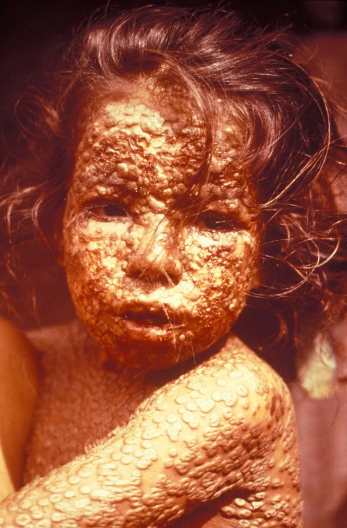 Dziecko chore na ospę prawdziwą (czarną ospę). Fotografia została wykonana w 1973 roku w Bangladeszu.