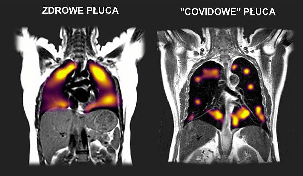 Covidowe płuca: Koronawirus uszkadza je 3 miesiące po zakażeniu [BADANIA]