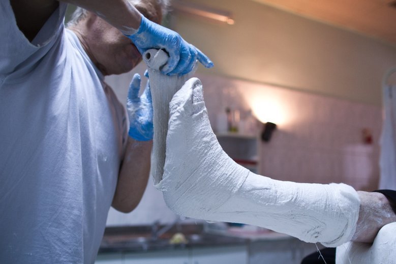 Osteoporoza może być przyczyną kalectwa u kobiet po 50. roku życia.