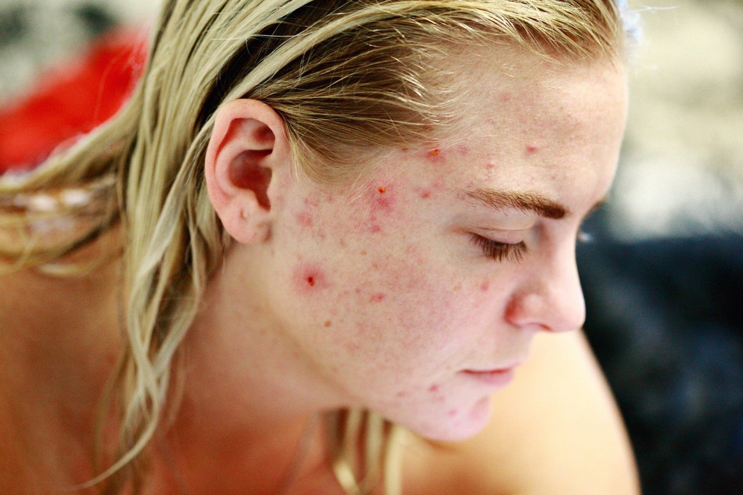 Tzw. trądzik z rozdrapania, znany również jako trądzik neuropatyczny, ma charakter zarówno dermatologiczny, jak i psychiczny