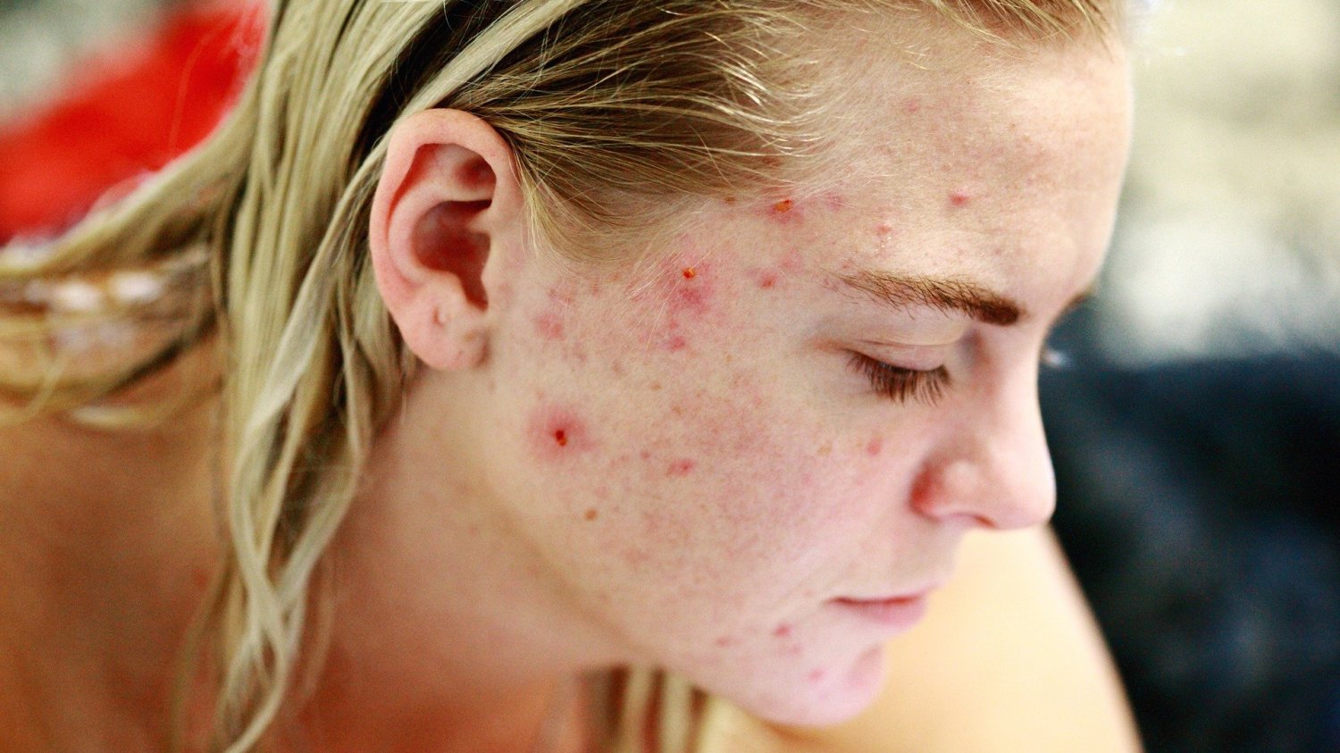 Tzw. trądzik z rozdrapania, znany również jako trądzik neuropatyczny, ma charakter zarówno dermatologiczny, jak i psychiczny