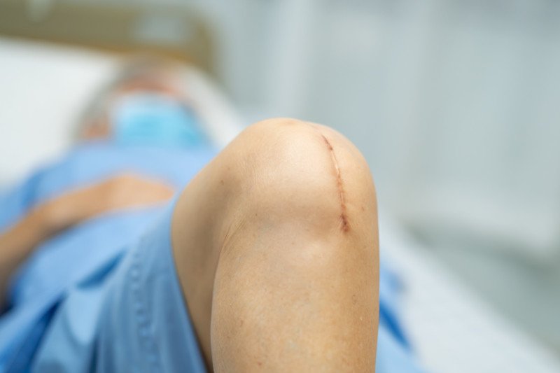 Blizna po artroskopii kolana