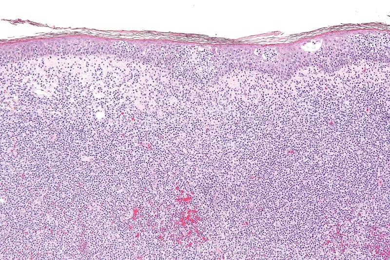 Preparat histologiczny naskórka zajętego przez chłoniaka CTCL