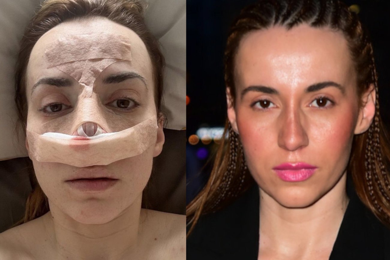 Marianna Schreiber poddała się operacji nosa.