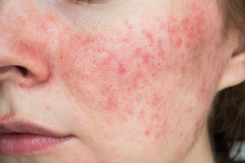 Kampania #WłączLeczenie zachęca, by mimo pandemii korzystać z usług dermatologów, aby skutecznie leczyć takie przewlekłe choroby skóry jak trądzik pospolity czy różowaty