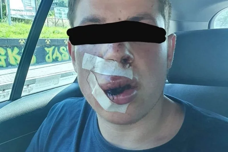 Student z Ukrainy został ciężko pobity gdy wyjawił , skąd przyjechał. Jest nagroda za wskazanie sprawców.