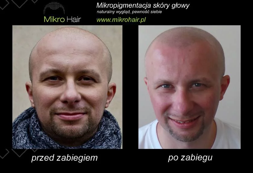 Rzadko który pacjent decyduje się pokazać twarz. Tak ogromnym kompleksem jest utrata włosów...