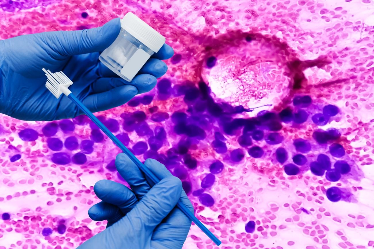 Darmowa cytologia z testem HPV na NFZ. Zapisz się sama przez internet