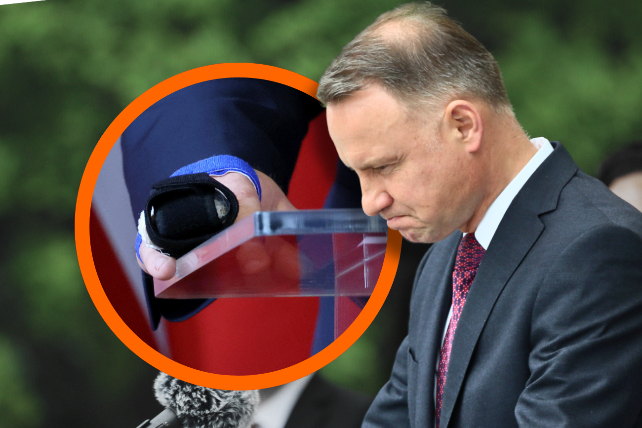 Palec prezydenta Dudy wygląda koszmarnie. Duda stracił koniuszek i paznokieć