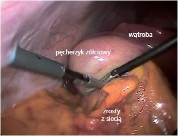 Na zdjęciu widoczne pęcherzyk żółciowy oraz narzędzia chirurgiczne, wprowadzone przez mikroporty do jamy brzusznej.