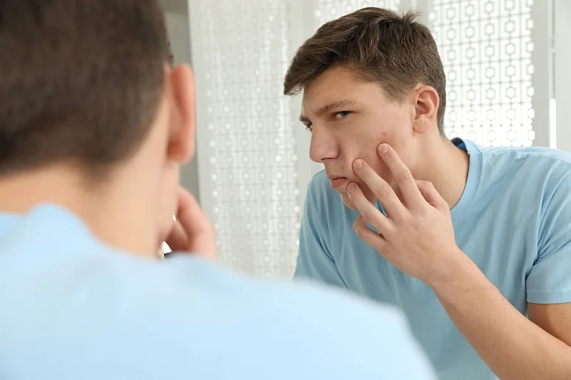 Trądzik jest przewlekłą chorobą skóry, która wymaga troski i regularności, czyli długotrwałej terapii