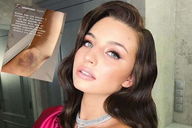 Siniaki po pobieraniu krwi zdarzają się często. Julia Wieniawa uważa, że to brak profesjonalizmu medyków.