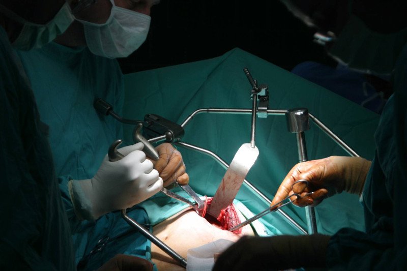 Zabieg przeszczepienia nerki.