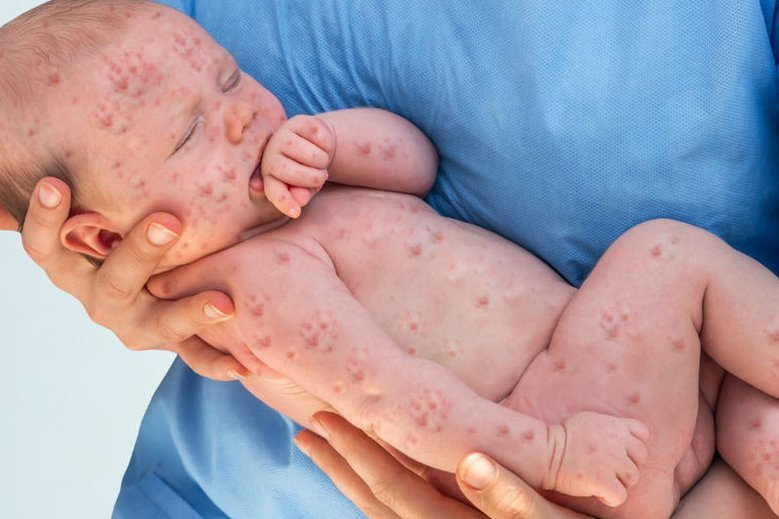 Odra to bardzo niebezpieczna choroba, która z powodu niedostatecznej liczby szczepień wróciła do Polski.