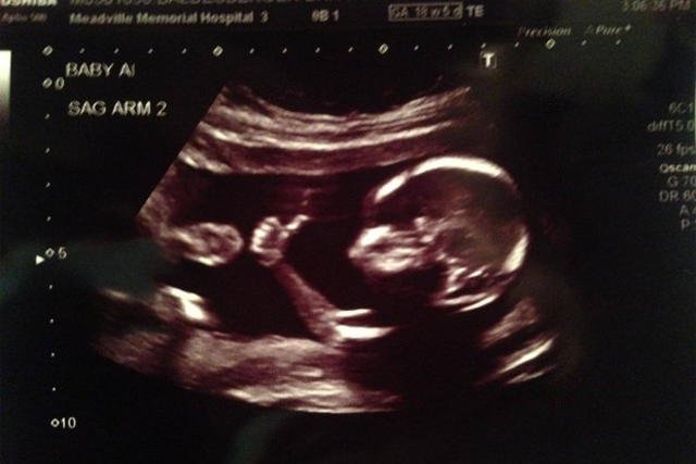 Na tym zdjęciu USG dziecko trzymało kciuk do góry