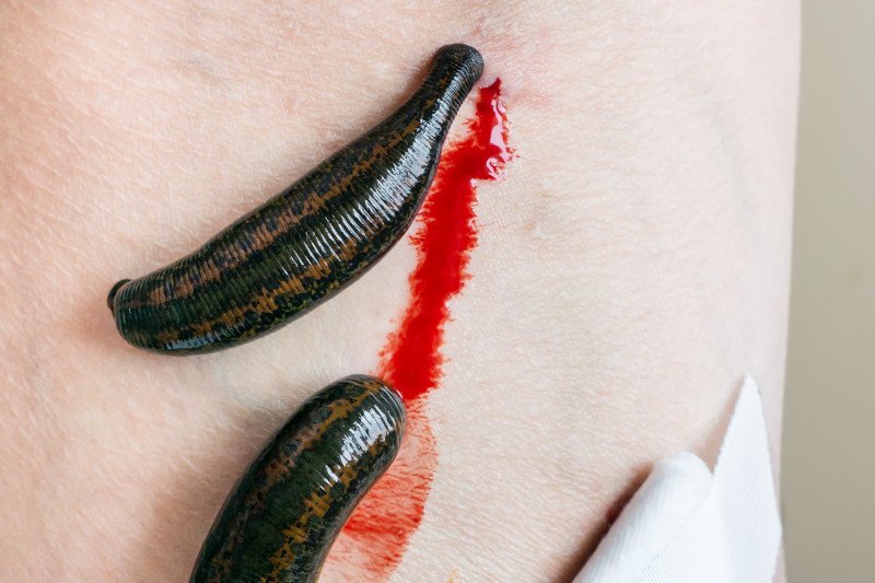 Hirudoterapia - "terapia" pijawkami - wywodzi się z pseudonaukowej flebotomii