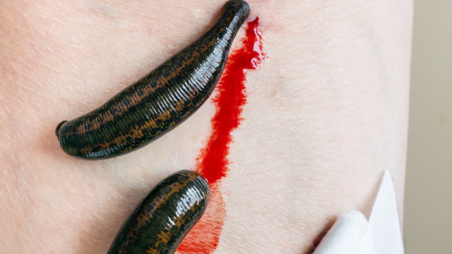 Hirudoterapia - "terapia" pijawkami - wywodzi się z pseudonaukowej flebotomii