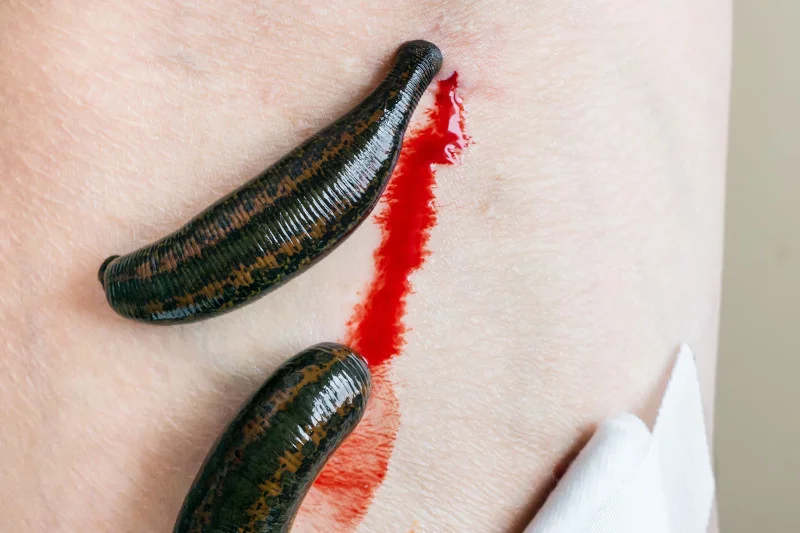 Hirudoterapia - "terapia" pijawkami - wywodzi się z pseudonaukowej flebotomii
