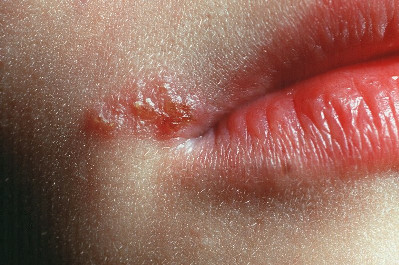 Za zimno na ustach odpowiedzialny jest wirus HSV