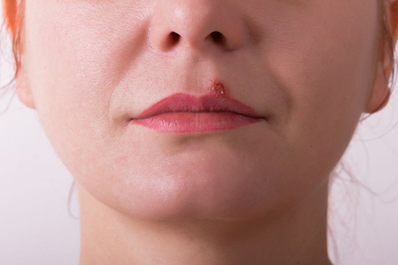 Opryszczka to nie tylko defekt kosmetyczny.