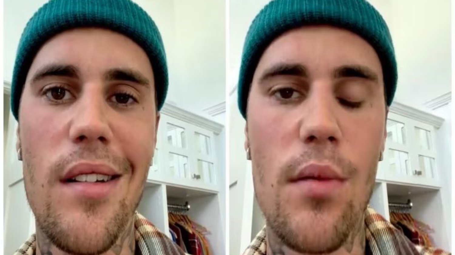 Justin Bieber - paraliż twarzy