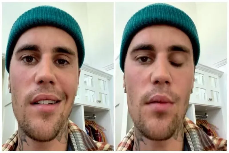 Justin Bieber - paraliż twarzy