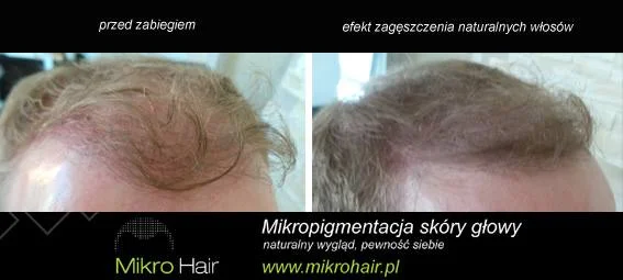 Mikro Hair