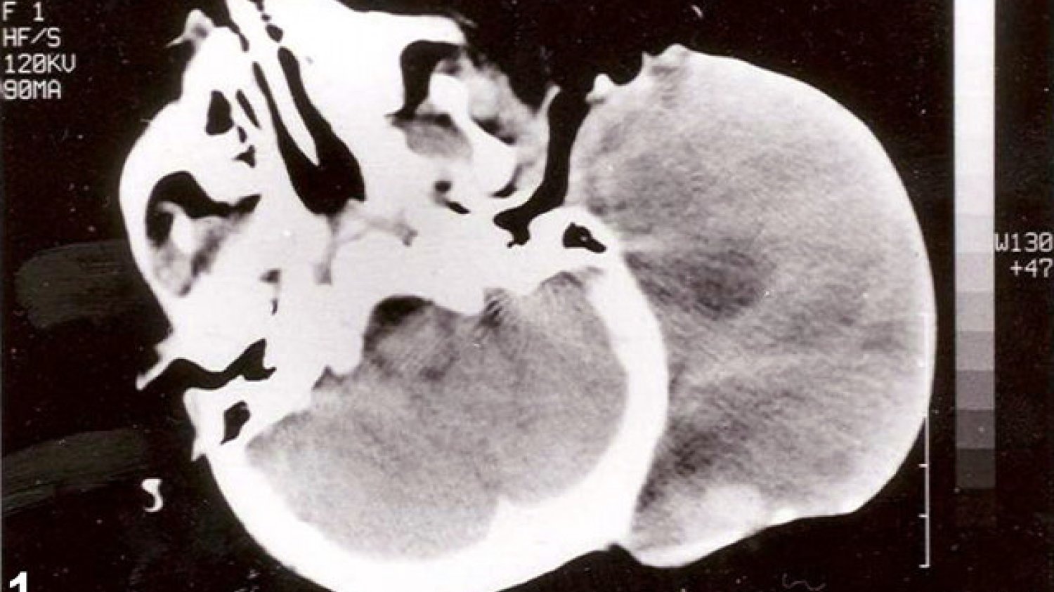 WHO uważa, że w ciągu najbliższych dekad będzie się diagnozować coraz więcej nowotworów złośliwych