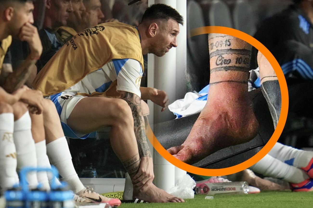 Leo Messi doznał kontuzji po faulu kolumbijskiego rywala w finale Copa America 2024. Leo Messi doznał kontuzji po faulu kolumbijskiego rywala w finale Copa America 2024.