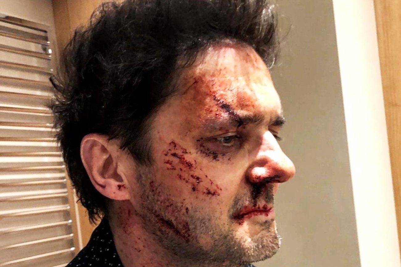 Kuba Wojewódzki został dotkliwie pobity? Showman wyjaśnił, skąd obita twarz