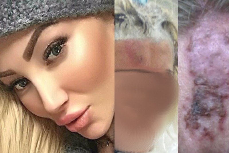 Pani Marta utrzymuje, że wskutek zabiegu wykonanego przez Paulinę Pszech dostała martwicy.