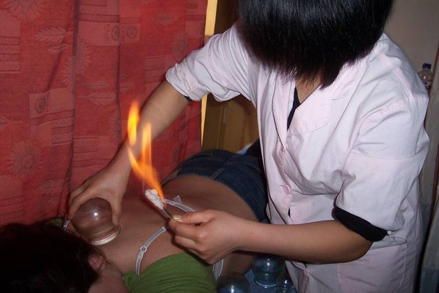 Stawianie baniek ogniowych.